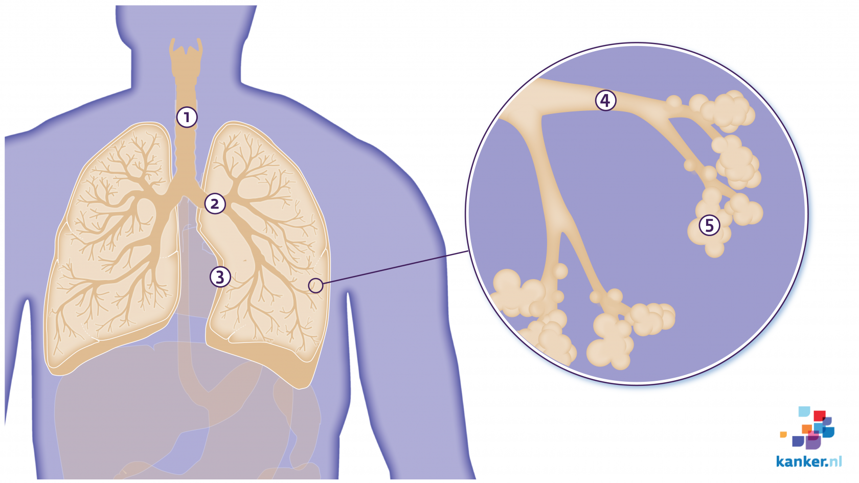 Longkanker - Instituut Asbestslachtoffers